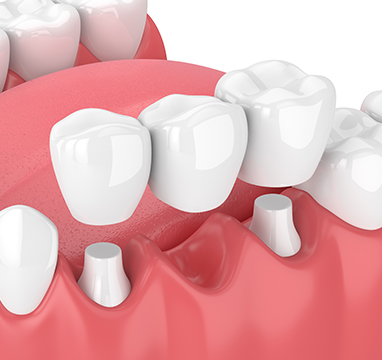 SW Calgary Dental Bridges | Wentworth Family Dental | General & Family Dentist | SW Calgary