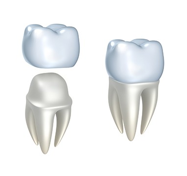 SW Calgary Dental Crowns | Wentworth Family Dental | General & Family Dentist | SW Calgary