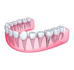 SW Calgary Dental Implants | Wentworth Family Dental | General & Family Dentist | SW Calgary