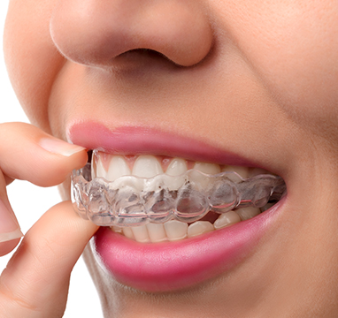 SW Calgary Invisalign® | Wentworth Family Dental | General & Family Dentist | SW Calgary