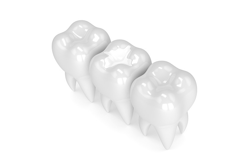 Teeth Repair Kit, Dental Temporary Filling, Temporary False Teeth