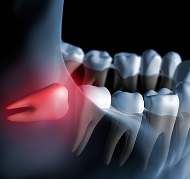 SW Calgary Wisdom Teeth Extraction | Wentworth Family Dental | General & Family Dentist | SW Calgary